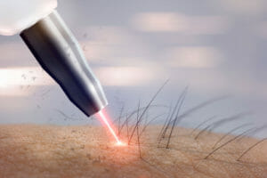 Depilazione laser