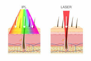 Depilazione laser vs IPL