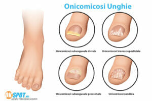 Infografica micosi unghie