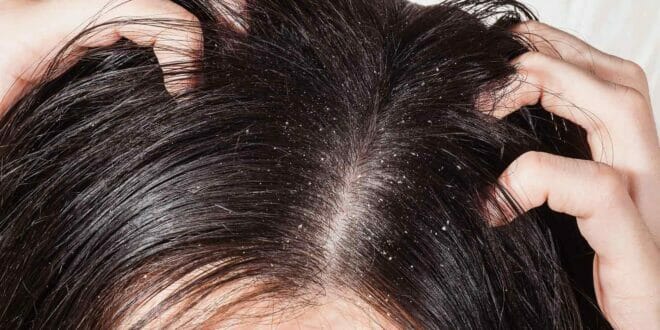 Migliori Shampoo Antiforfora